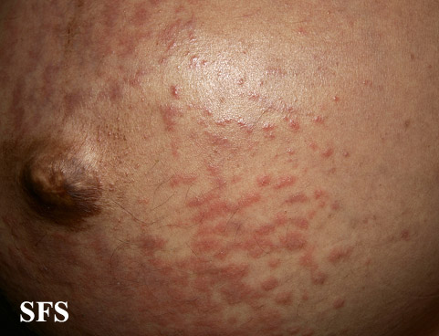 Pruritic urticarial papules and plaques of pregnancy. With permission from Dermatology Atlas.[7]