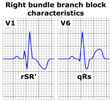 Right bundle branch block ECG characteristics.png