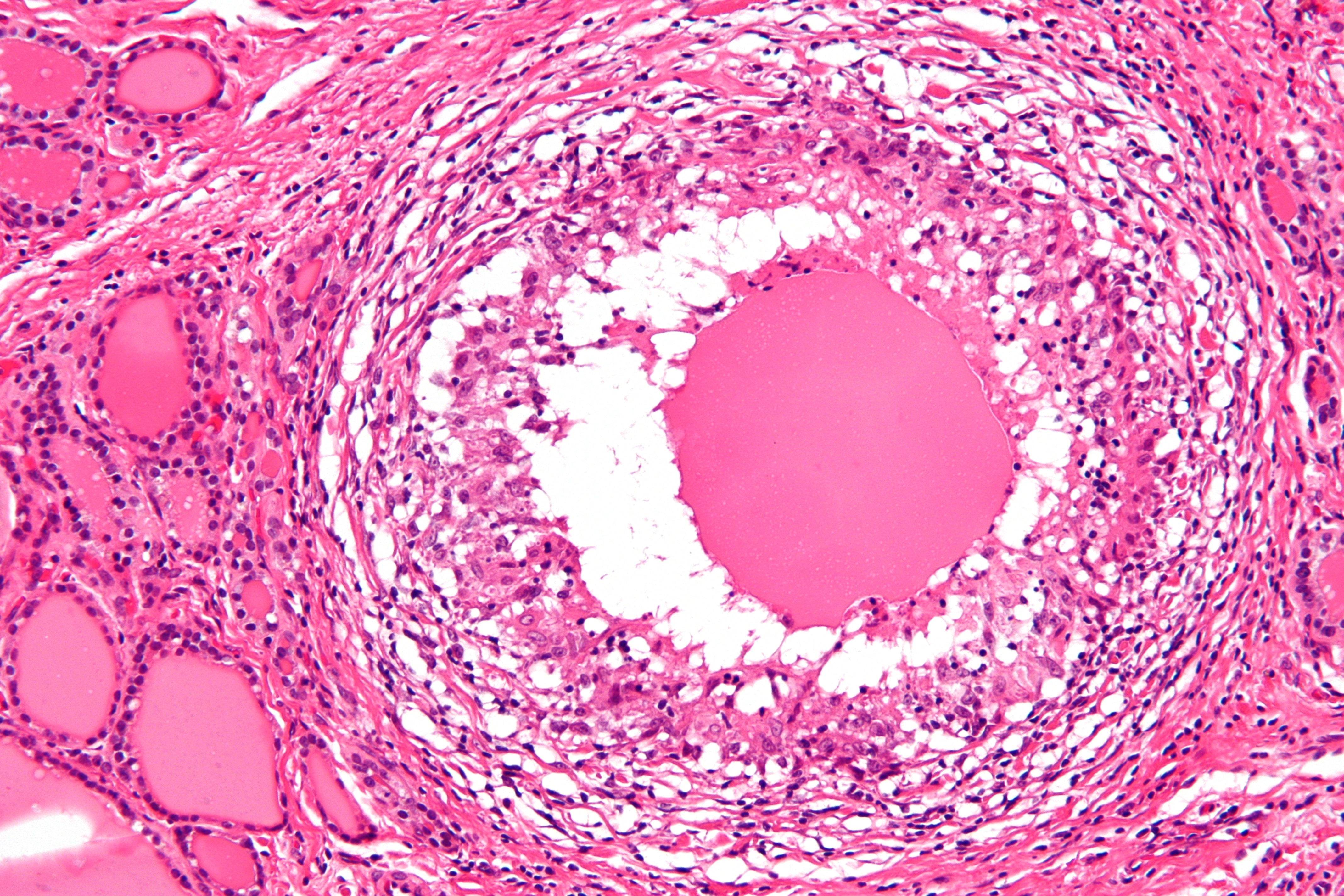 Histology of De Quervain's thyroiditis; Granuloma (By Nephron - Own work, CC BY-SA 3.0, https://commons.wikimedia.org/w/index.php?curid=18491421)