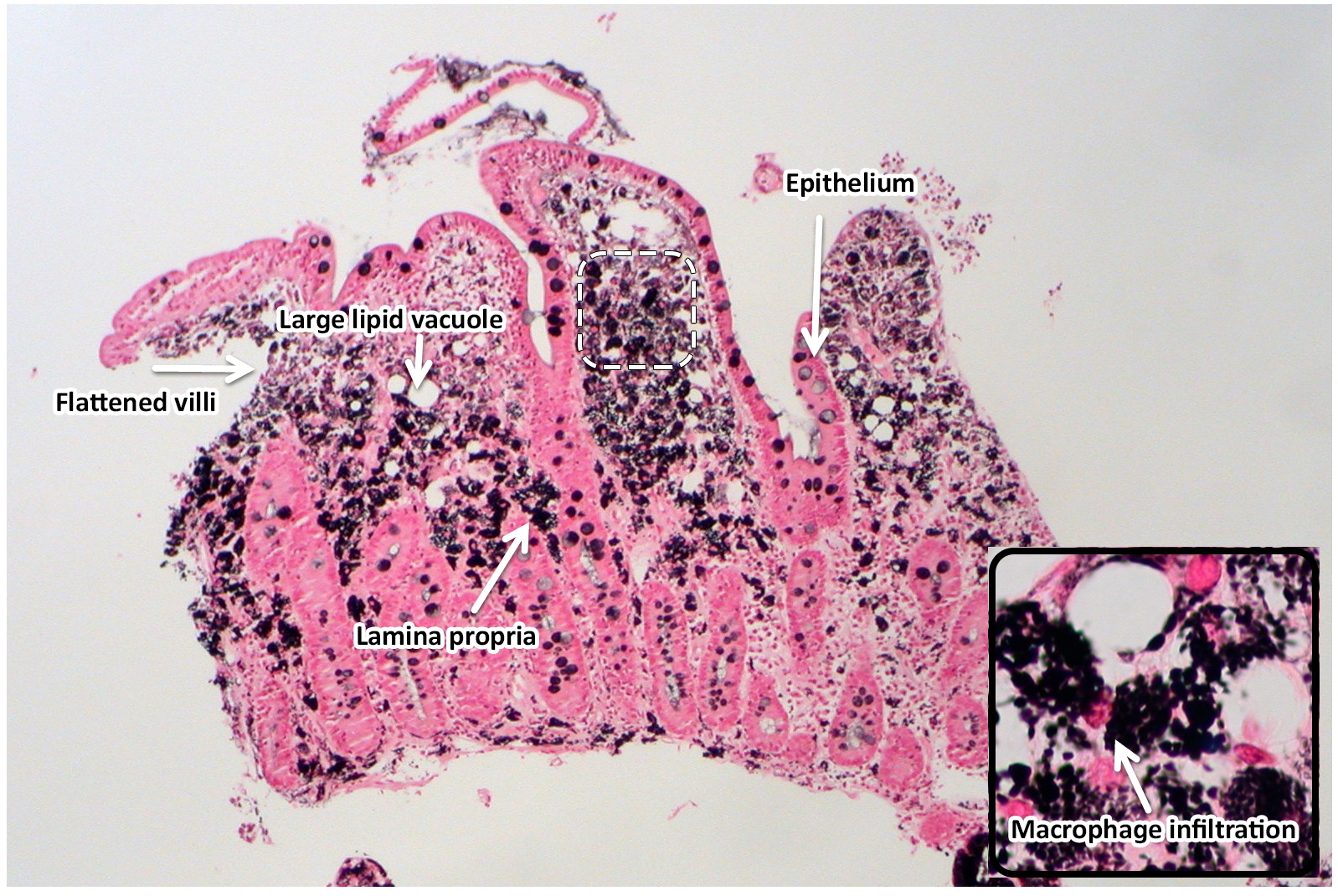 File:Whipple disease GMS stain.jpg