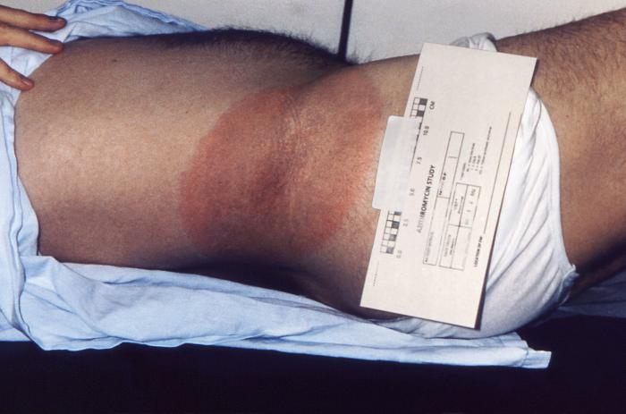 Right hip and waist region of a patient who’d presented with the erythema migrans (EM) rash characteristic of what was diagnosed as Lyme disease. From Public Health Image Library (PHIL). [2]