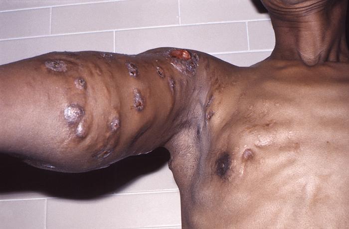 Anterior perspective of patient with nocardiosis infection of his right upper arm due to Gram-positive Nocardia brasiliensis bacteria. From Public Health Image Library (PHIL). [3]