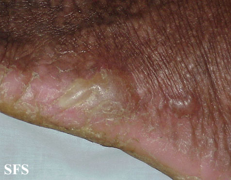 File:Darier's disease32.jpg
