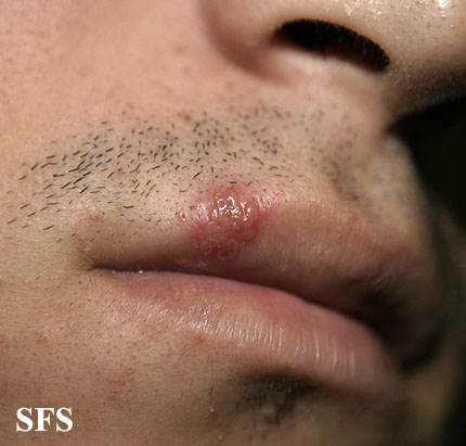 File:Herpes simplex 32.jpeg