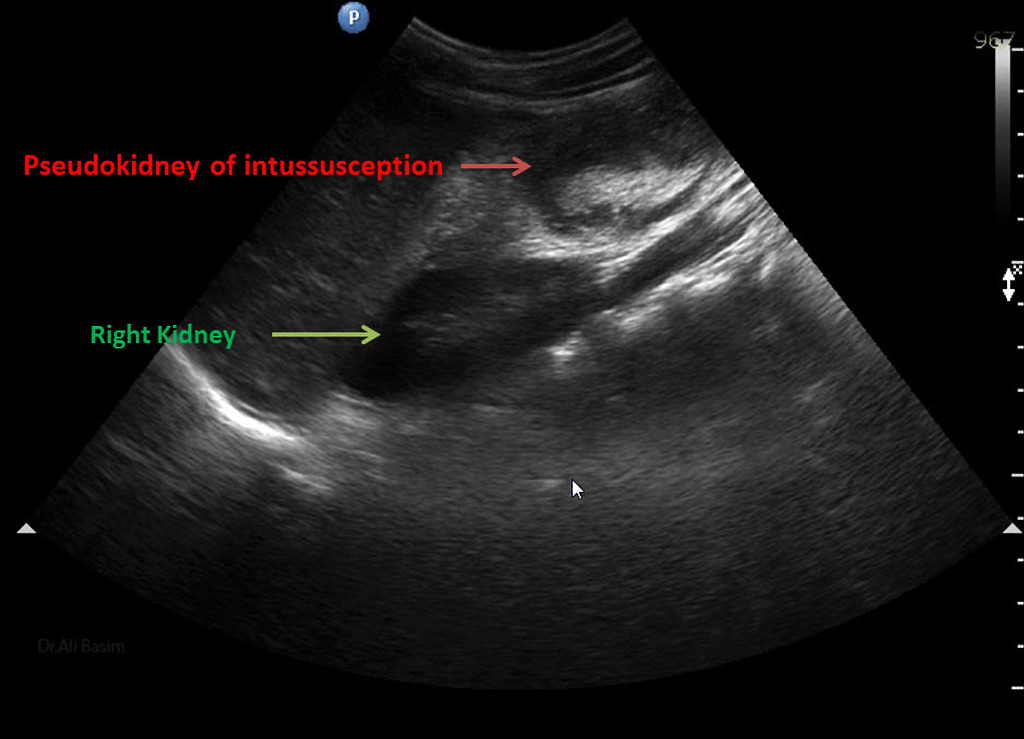 File:Intussusception- Pseudokidney sign.jpg