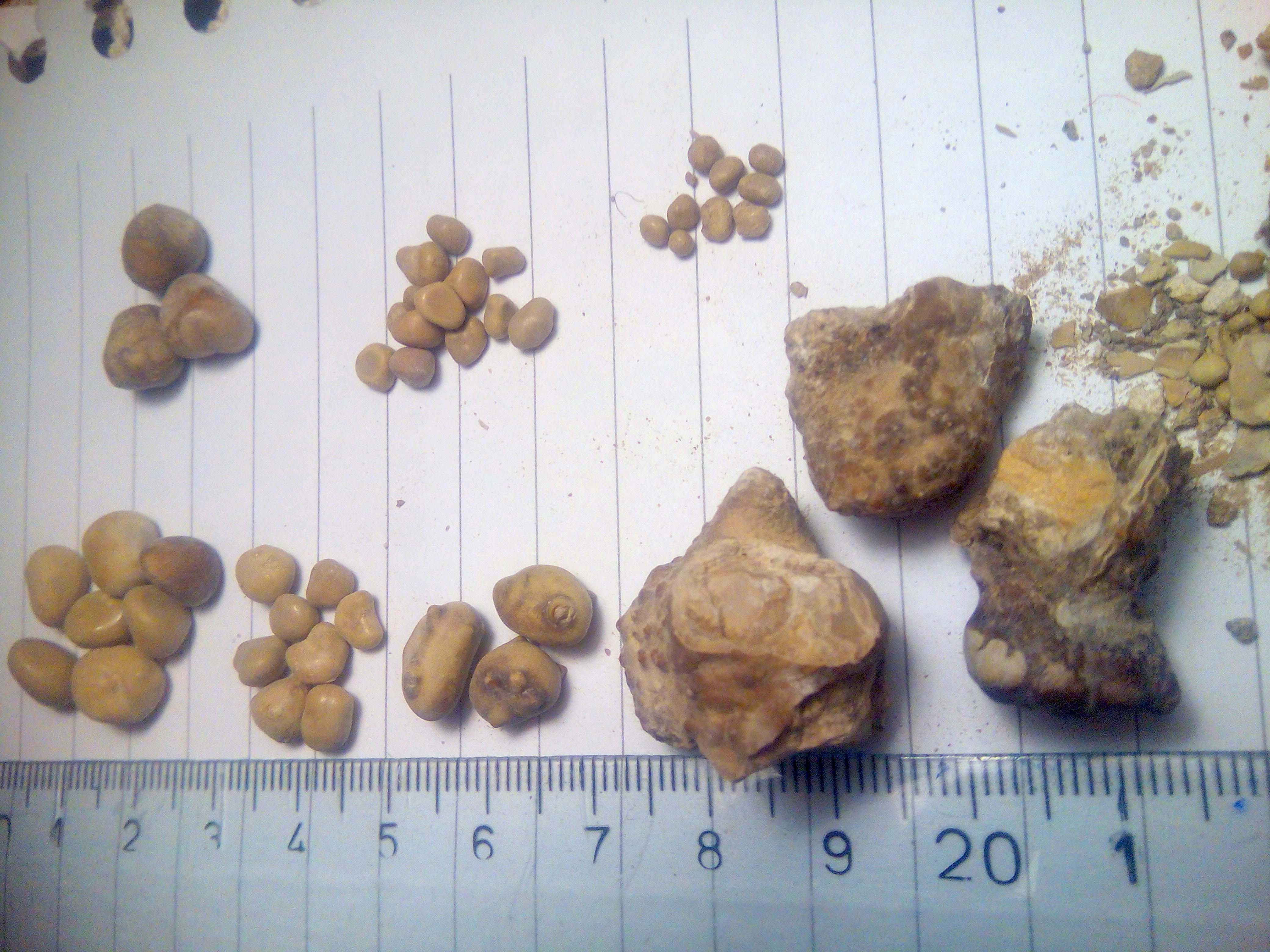 Renal calculi, different shapes and sizes, Source: Wikimedia commons[5]