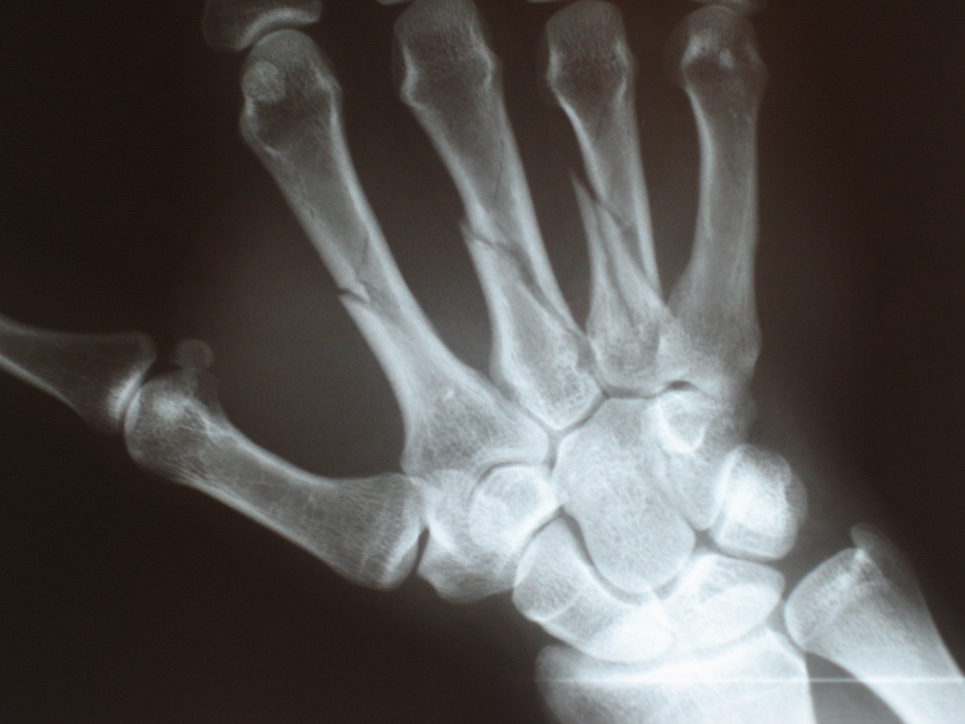Multiple fractures of the metacarpals (aka broken hand).
