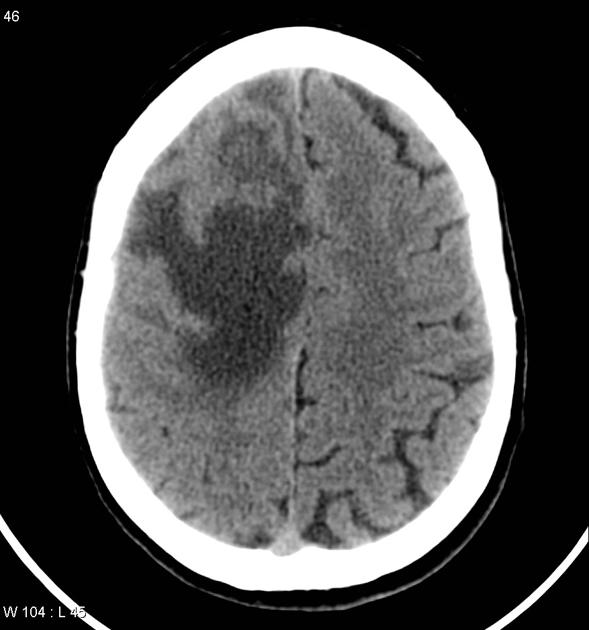 File:CT scan of brain metastasis 3.jpg