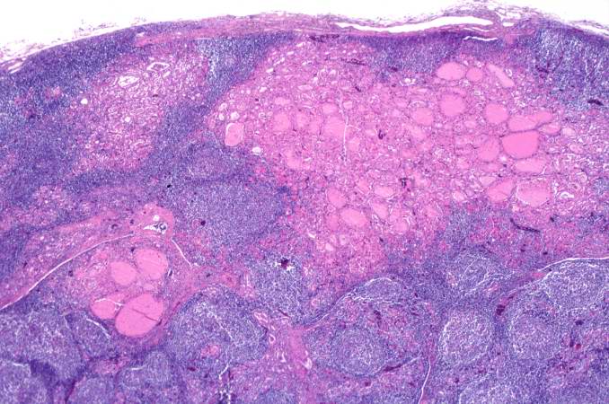 This is another higher-power photomicrograph of thyroid from this case showing the inflammatory cells and the residual thyroid tissue.