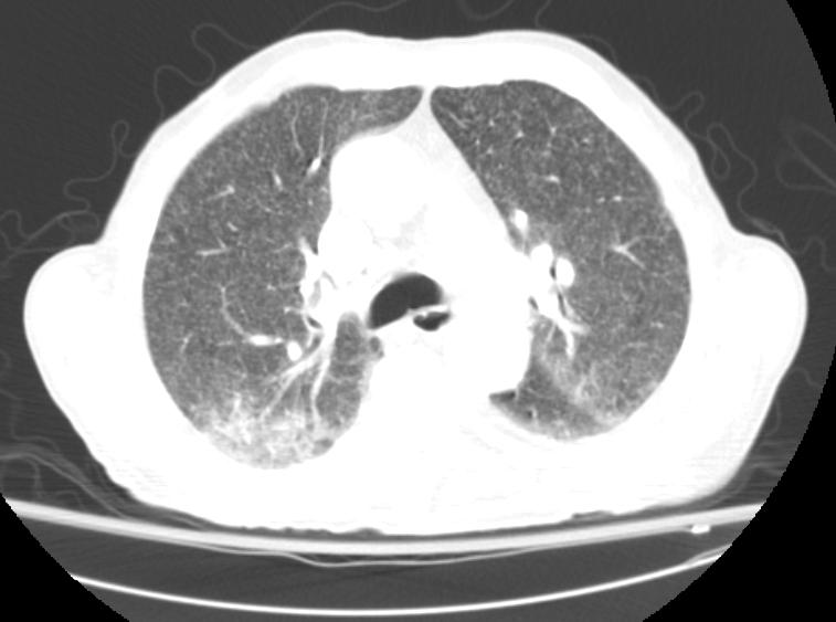 File:Miliary tuberculosis CT 102.jpg