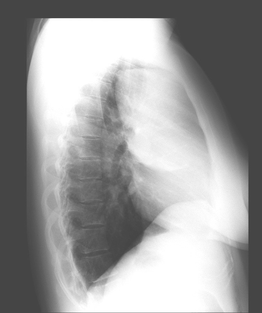 File:LATERAL VIEW OF BRONCHOGENIC CYST.jpeg
