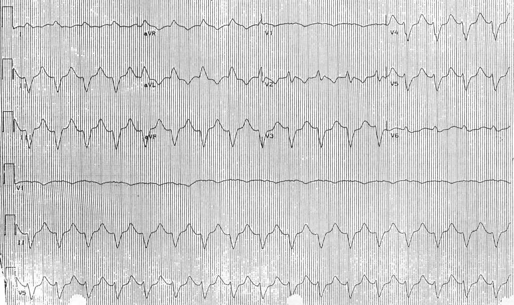 Left Bundle Branch Block Image courtesy of C. Michael Gibson MS MD and Copylefted