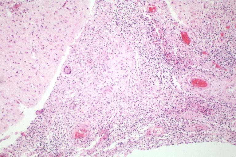 Tuberculous Meningitis: Micro low mag H&E. An excellent example with giant cells.