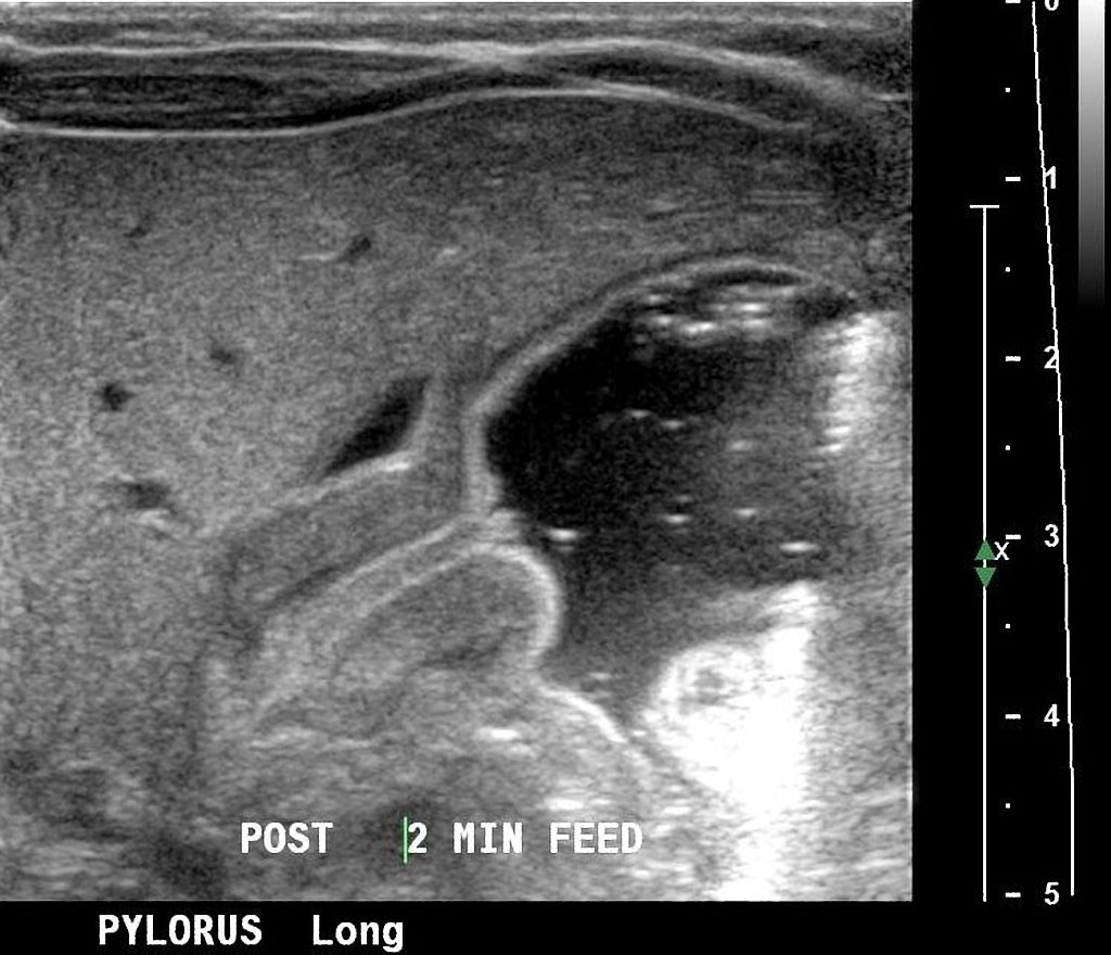 File:Pyloric-stenosis nipple sign.jpg