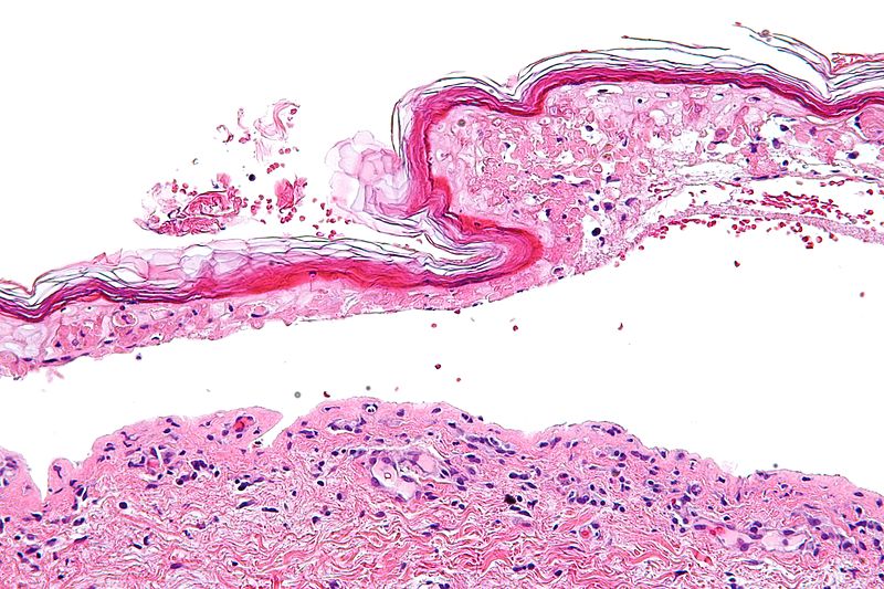 File:800px-Confluent epidermal necrosis - high mag.jpg