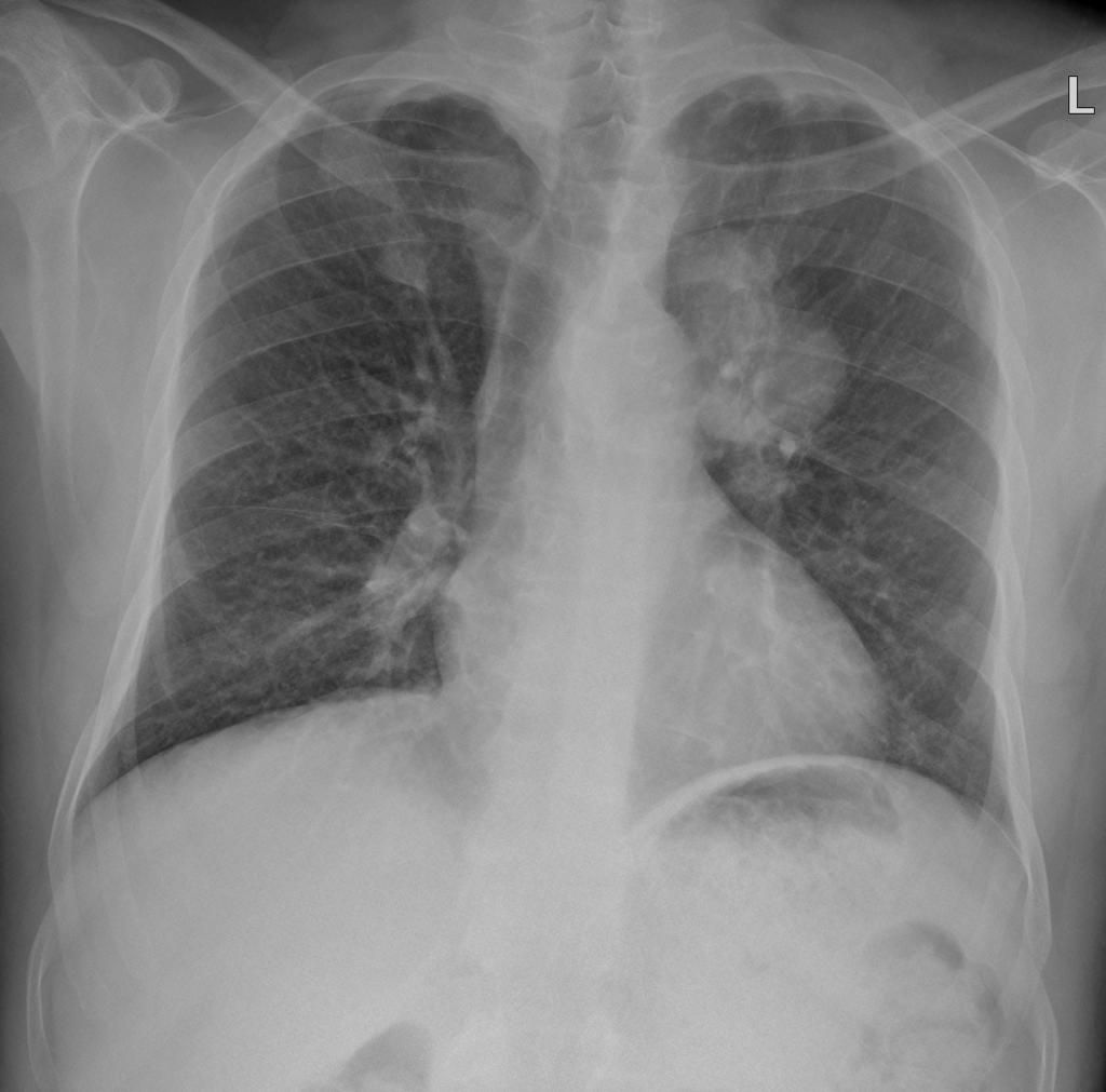 Chest x-ray of a 60 year old male patient presented with altered mental status, headache of recent onset, and a history of shortness of breath demonstrated a large lung mass.[2]