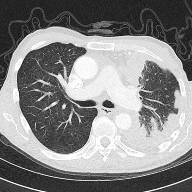 CT scan of chest demonstrating a circumferential nodular soft tissue encasement of the left lung. There is volume loss with elevation of the hemidiaphragm and shift of the mediastinum. A number of enlarged mediastinal nodes are noted.[2]