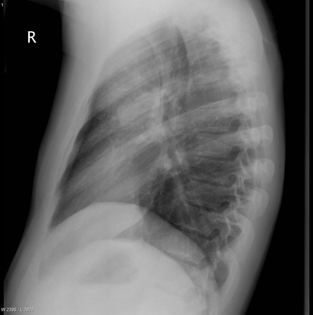 File:Hodgkin's lymphoma Lateral view Chest X ray .jpg