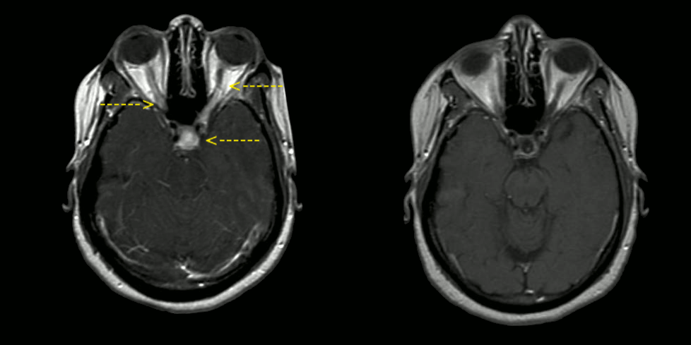 File:Neurosarcoidosis MRI pre-post treatment arrows.gif