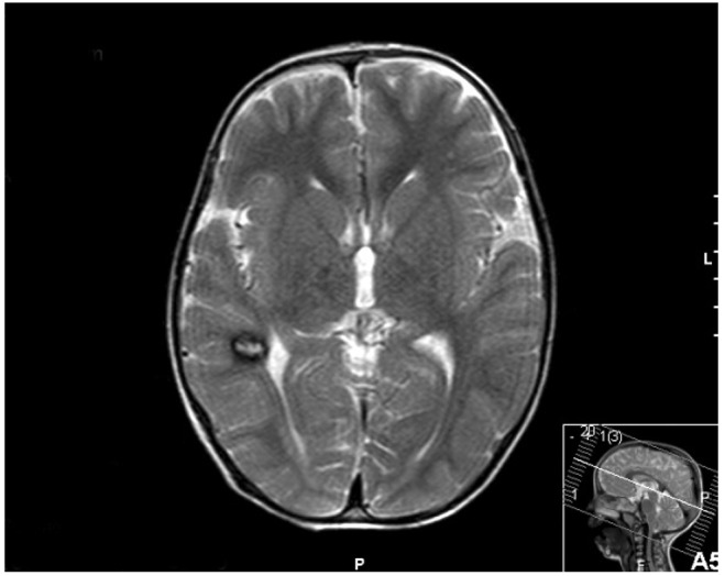 File:Proteus syndrome-Temporal lobe cavernoma.gif