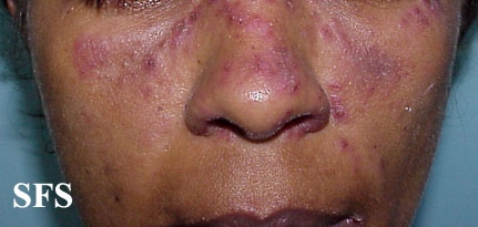 Subacute cutaneous lupus erythematosus. Adapted from Dermatology Atlas.[2]