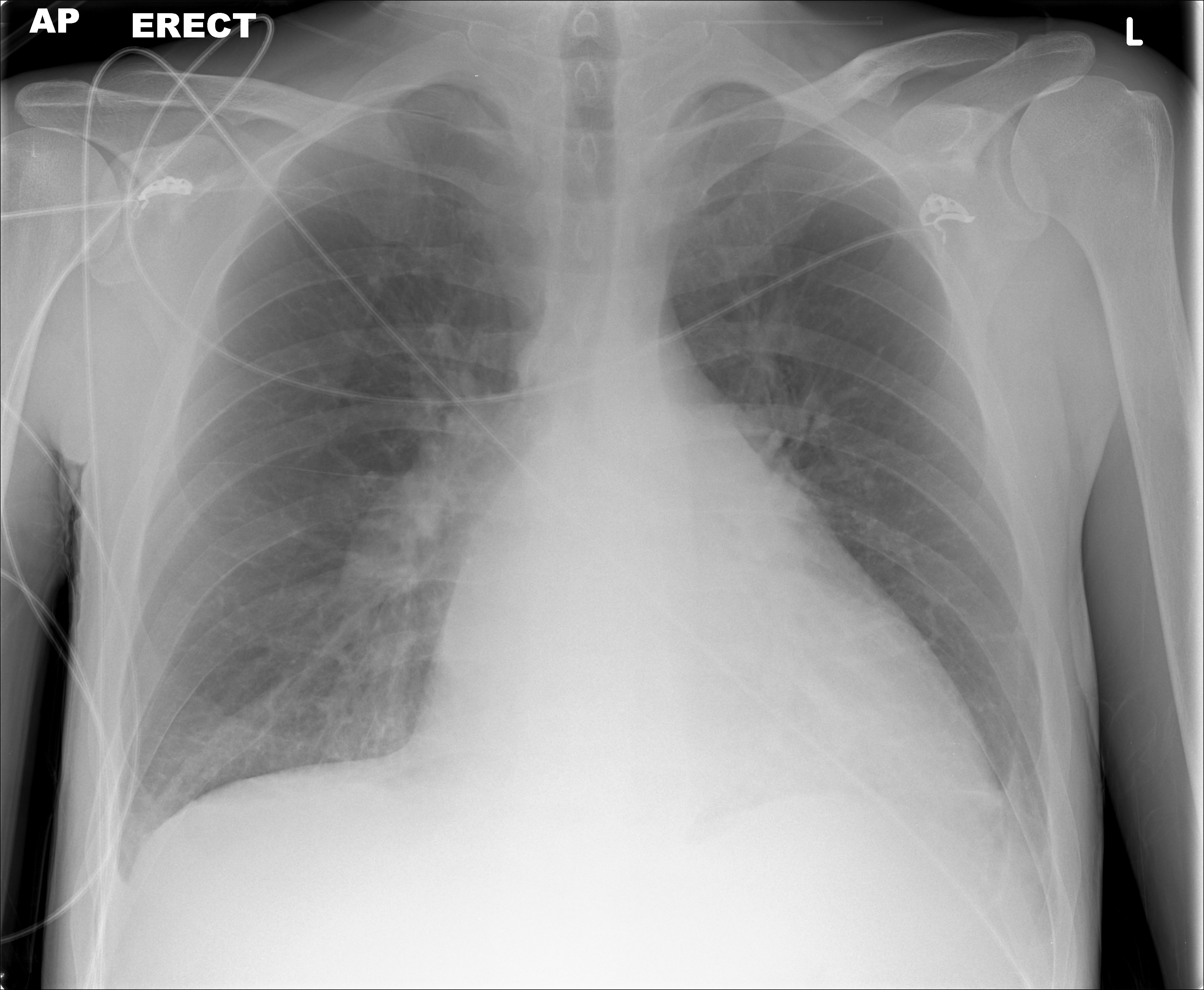 File:Tachycardia-mediated-cardiomyopathy.jpg