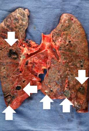 Gross photograph of the lung abscess. Note the abscesses (arrows) especially in the lower lobes.