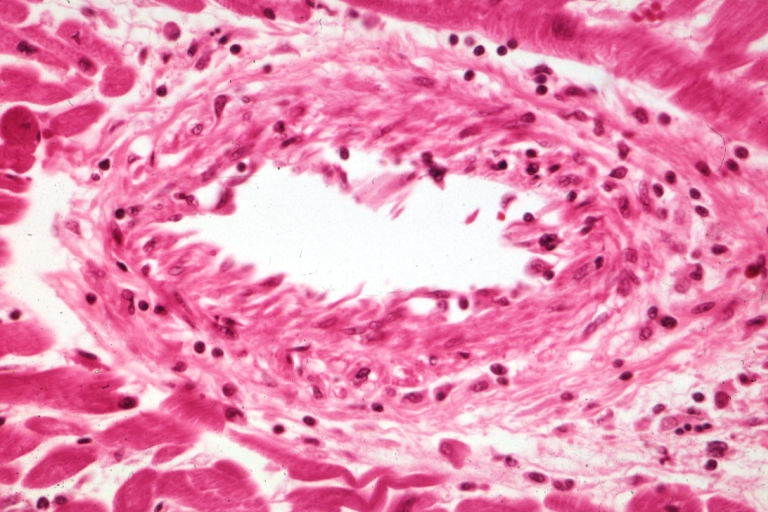 Coronary artery: Transplant Rejection: Micro high mag H&E small muscular artery vasculitis