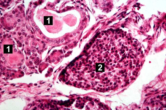 This is another high-power photomicrograph showing cystic spaces (1) within the acinar pancreas and a normal islet of Langerhans (2).