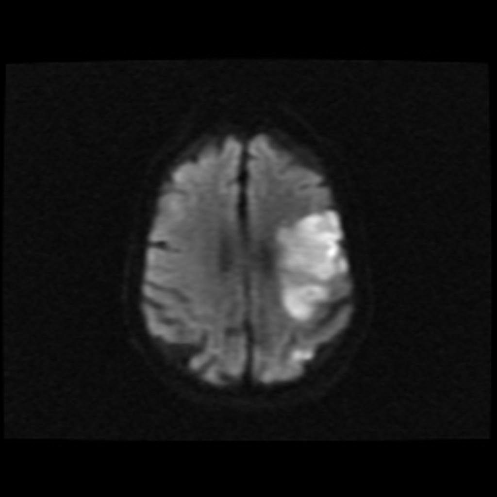 File:DWI left-middle-cerebral-artery-territory-infarct.jpg