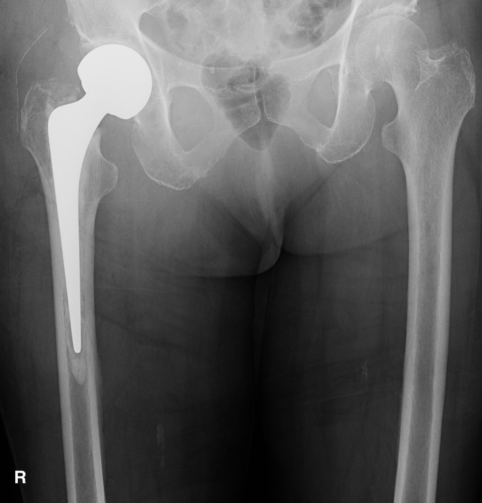 The right hip hemiarthroplasty is normally aligned and uncomplicated. There is a segment (approx 10cm) of disconnected surgical drain tubing in the lateral soft tissues of the left hip. Mild left hip osteoarthritis.