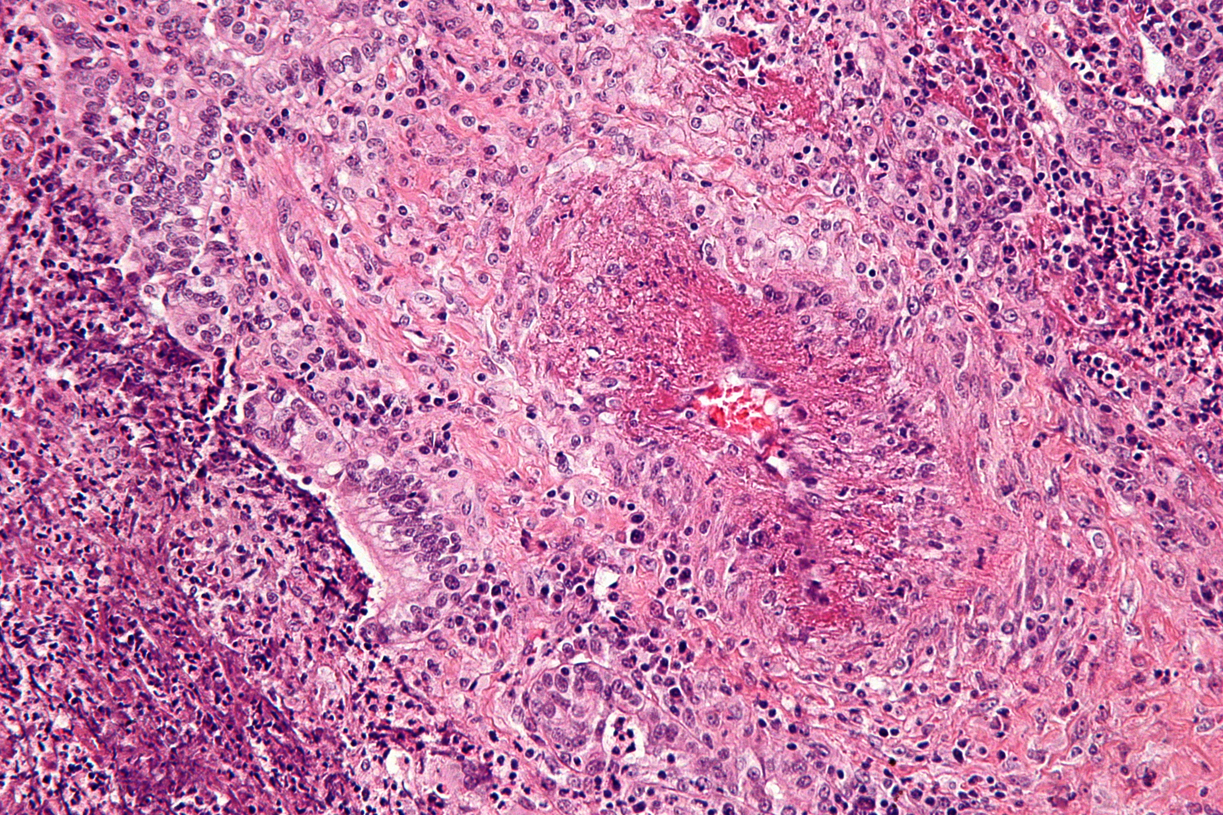 Granulomatosis with polyangiitis[16]