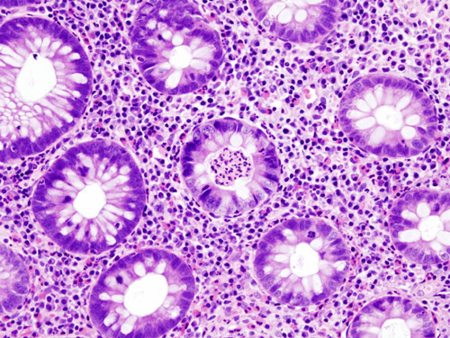 Ulcerative colitis. H&E staining showing crypt abscess, a characteristic finding in ulcerative colitis [47]