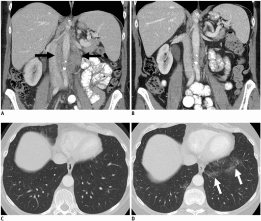 File:Ct before n after tx gif.gif