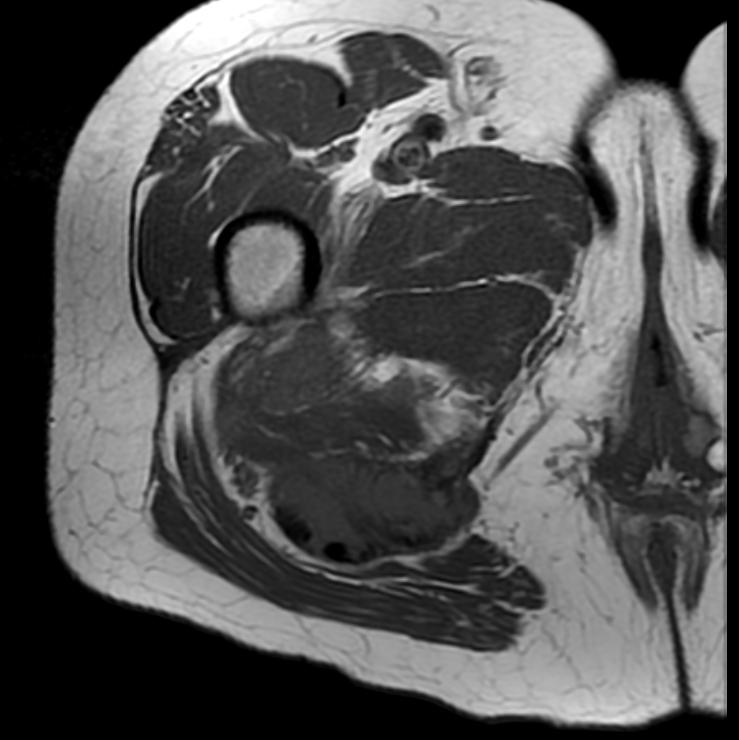 File:Hamstring tendon avulsion MRI 003.jpg