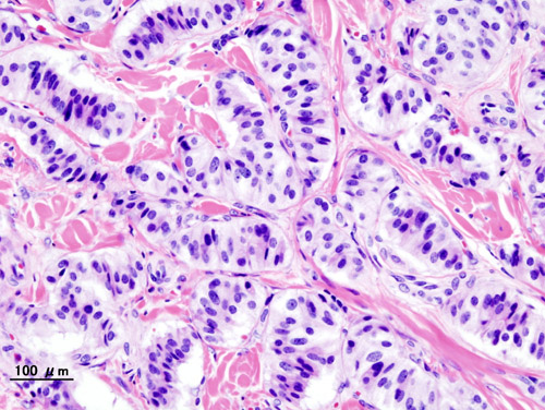 Histopathology of a pancreatic endocrine tumor (insulinoma). Source:https://librepathology.org/wiki/Neuroendocrine_tumour_of_the_pancreas[13]