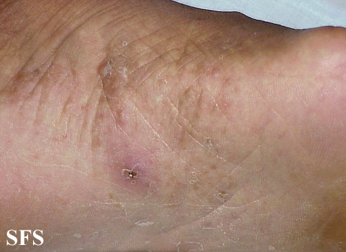 Tinea pedis. Adapted from Dermatology Atlas.[3]