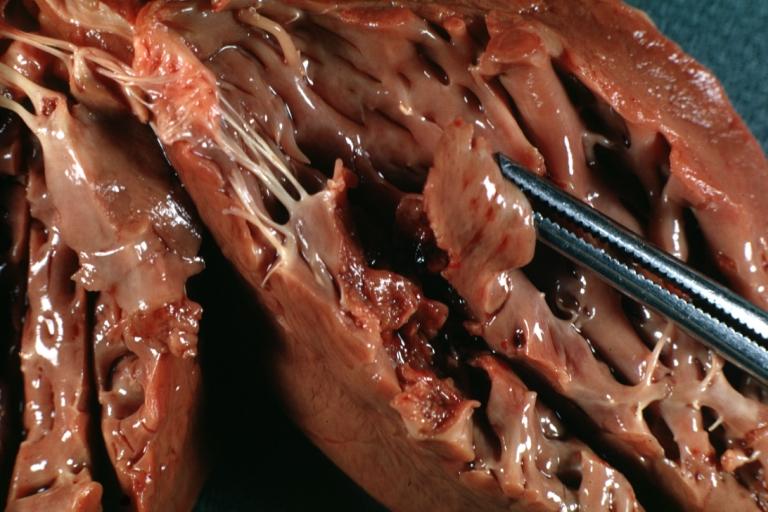 Papillary Muscle Infarct with Rupture: Gross, natural color, close-up, well shown
