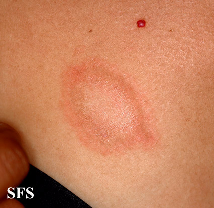 Pityriasis rosea. With permission from Dermatology Atlas.[1]