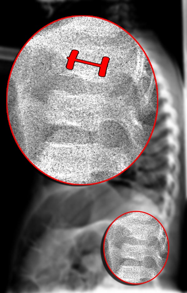 H shaped vertebral bodies