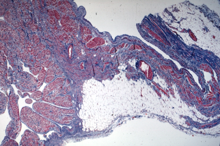 HEART: Sinus Node Fibrosis: Micro low mag trichrome, a nice photo to illustrate this lesion in 67yo Female with resected colon carcinoma metastases, infectious complications and arrhythmia