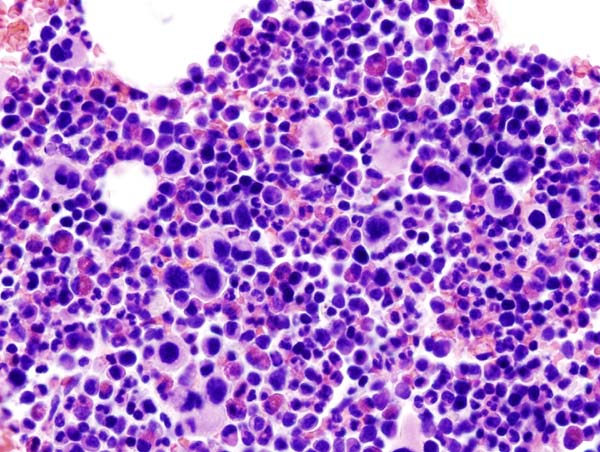 Histopathological image representing a bone marrow aspirate in a patient with essential thrombocythemia. Hematoxylin & eosin stain.[7]