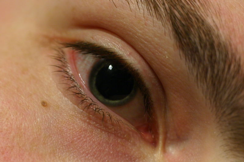 Pupil dilated using anaesthetic and muscle relaxant