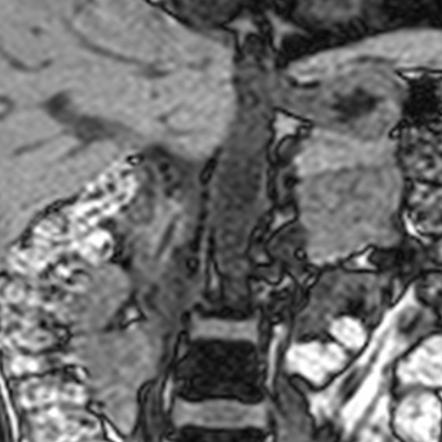 File:Pheochromocytoma MRI.jpg