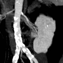 File:Renal artery stenosis 032.jpg