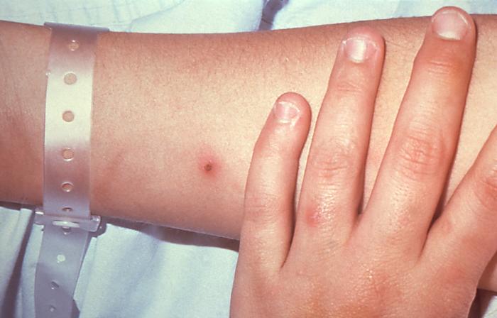 This patient presented with cutaneous lesions on the right forearm and left hand due to a N. gonorrhoeae infection.Though sexually transmitted, and involving the urogenital tract initially, a Neisseria gonorrhoeae bacterial infection can become disseminated systemically, manifesting itself as a cutaneous erythematous lesion anywhere on the body.
