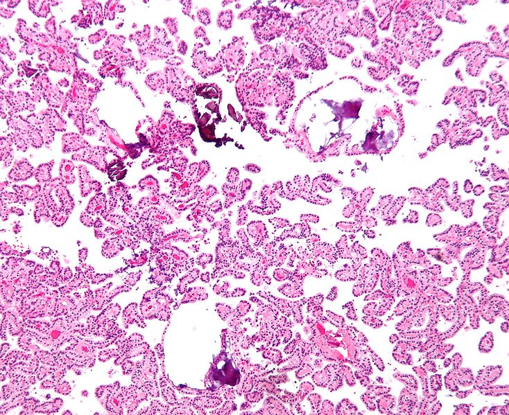 Shown above is a micrograph of choroid plexus papilloma (H&E stain).