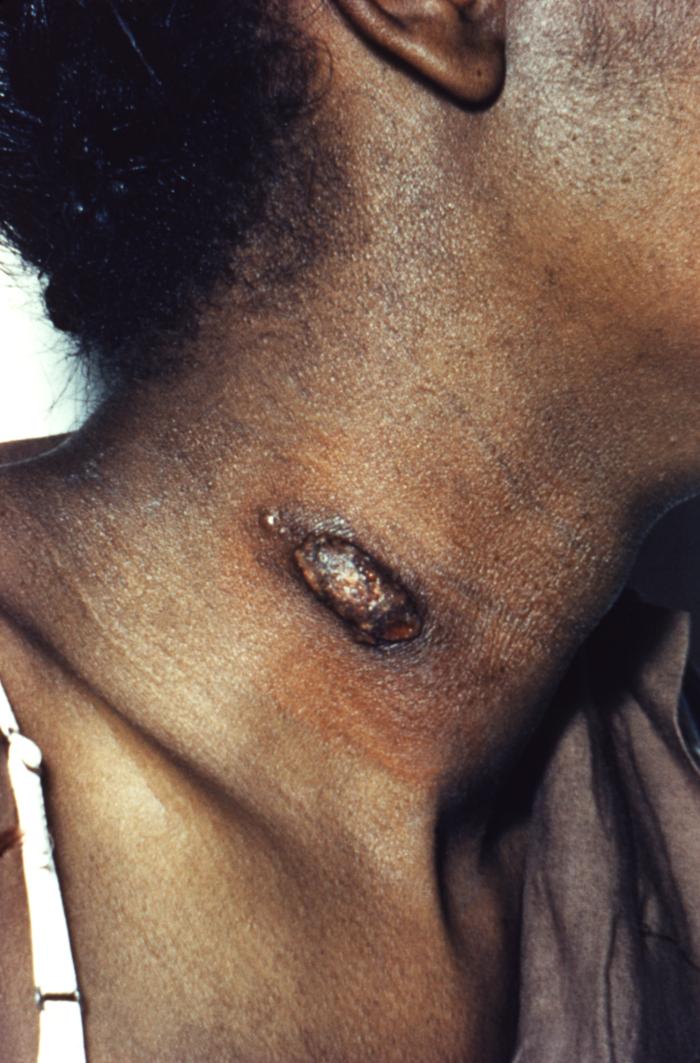 Chronic lesion that had been determined to be due to a Coccidioides sp. fungal infection. From Public Health Image Library (PHIL). [6]