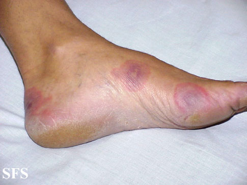 .:Erythema multiforme Adapted from Dermatology Atlas.[1]