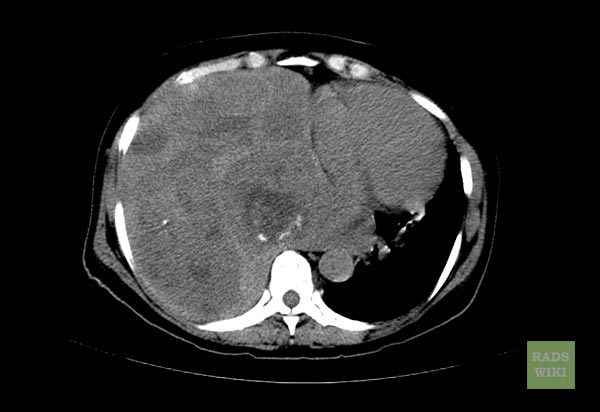 File:Fibrous-tumor-pleura-004.jpg